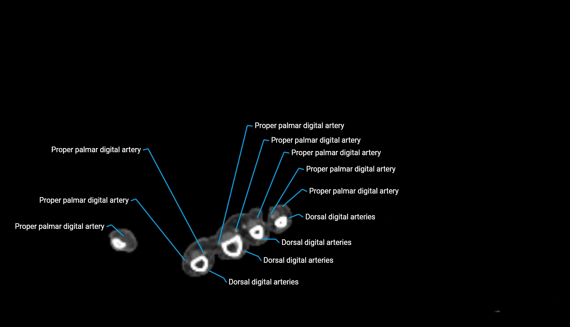 CTA upper limb axial cross sectional anatomy labelled image 39 (2).webp
